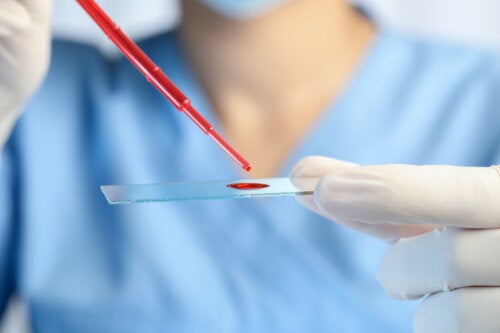 Leucemia eosinofílica crônica: sintomas, diagnóstico e tratamento