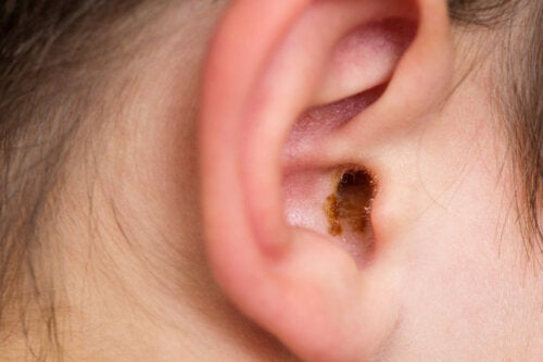 Obstrução do canal auditivo por cerume