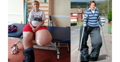 O que é a síndrome de Proteus? Conheça os sintomas, causas e tratamento