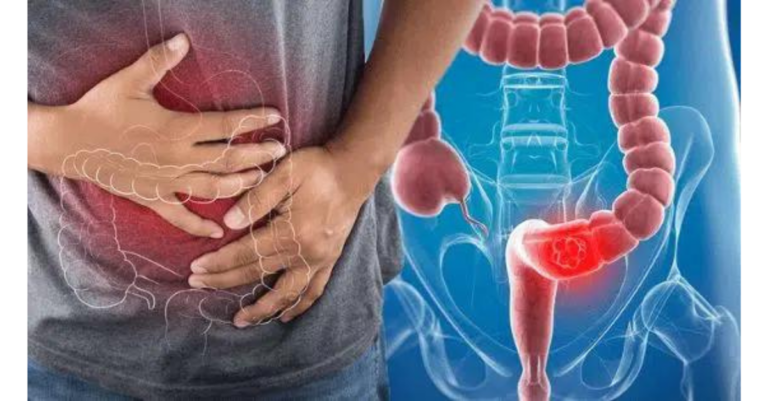 Câncer de intestino: os casos estão aumentando entre os mais jovens