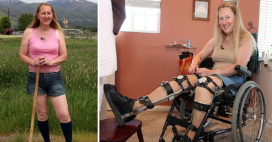 Mulher com transtorno de identidade de integridade corporal tenta se amputar e deseja ser paraplégica