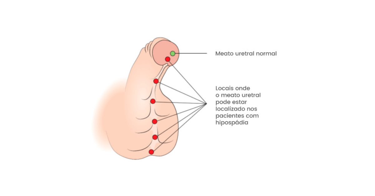 Hipospádia: o que é a condição que afeta o rapper Lil Dicky?