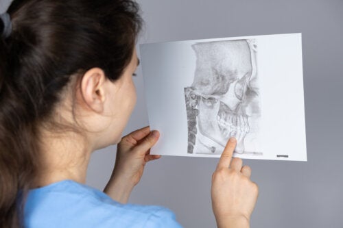 O que é retrognatismo mandibular e qual o seu tratamento?