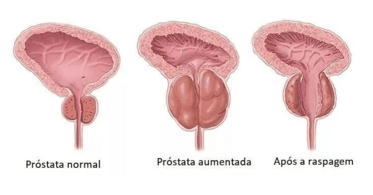 Cirurgia de raspagem da próstata conheça como funciona o procedimento feito por Raul Gil Cirurgia de raspagem da próstata conheça como funciona o procedimento feito por Raul Gil