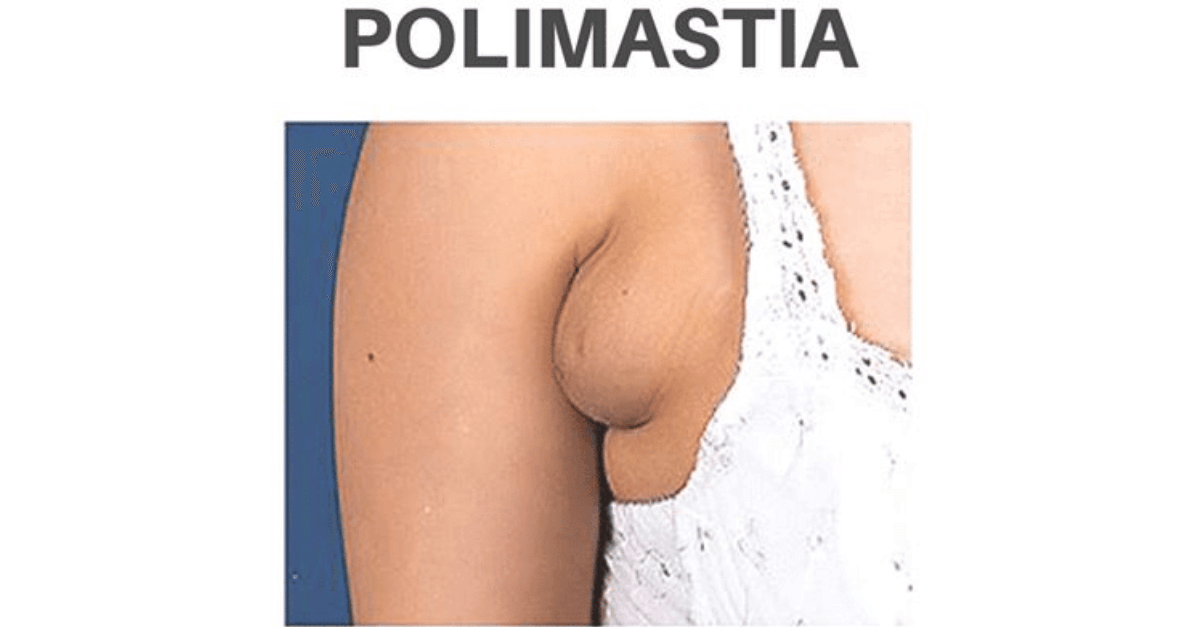 Polimastia: Tata Estaniecki descobre terceiro mamilo na axila