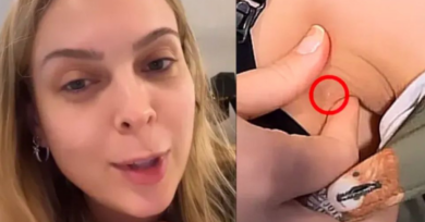 Polimastia: Tata Estaniecki descobre terceiro mamilo na axila