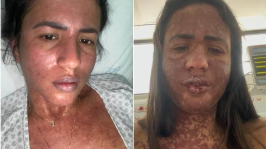 Síndrome de Stevens-Johnson: "achei que ia morrer"