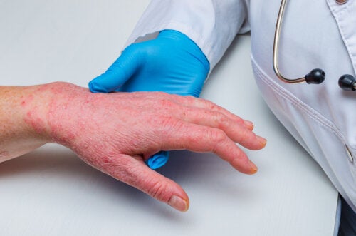 Sintomas e tratamentos de dermatite nas mãos