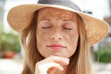 Hiperpigmentação após o verão: o que funciona e o que pode agravar as manchas